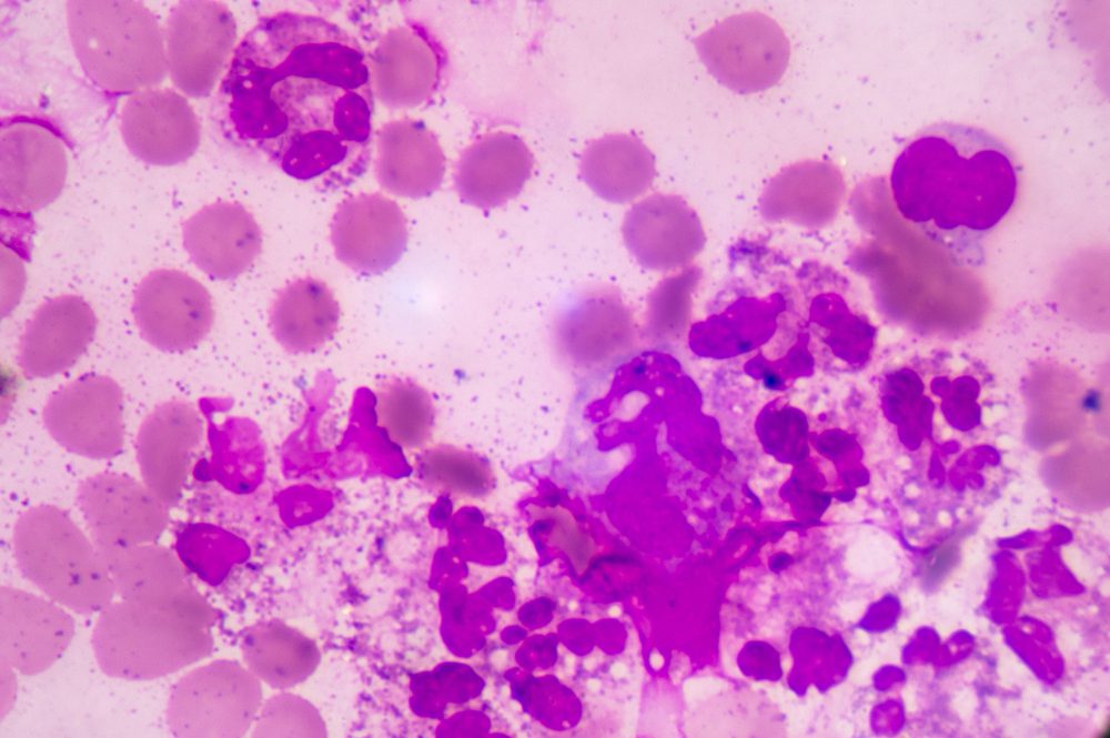 Abnormal neutrophil in pleural fluid smear.Sepsis or septicaemia is a life-threatening illness. Presence of numerous bacteria in the blood, causes the body to respond in organ dysfunction. 