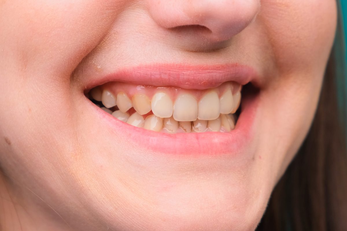 female with yellow teeth due to fluorosis