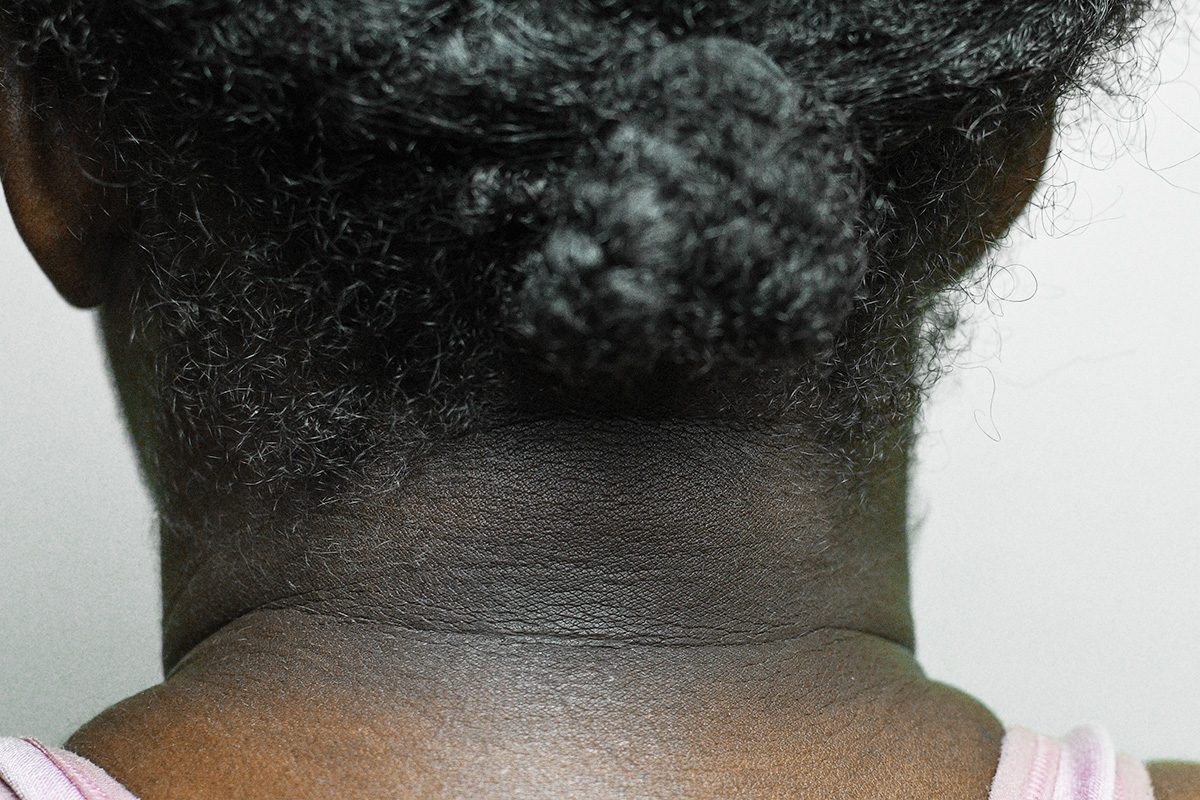 Odd Symptoms Of Type 2 Daibeties 