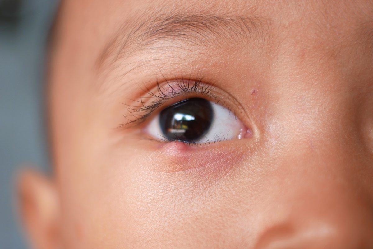 How To Get Rid of a Stye—the Right Way, According to Expert Eye Doctors