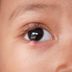 How To Get Rid of a Stye—the Right Way, According to Expert Eye Doctors